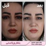 بلفاروپلاستی