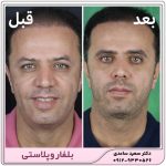 بلفاروپلاستی