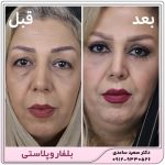 بلفاروپلاستی