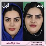 بلفاروپلاستی