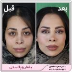 بلفاروپلاستی