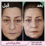 بلفاروپلاستی