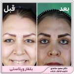 بلفاروپلاستی
