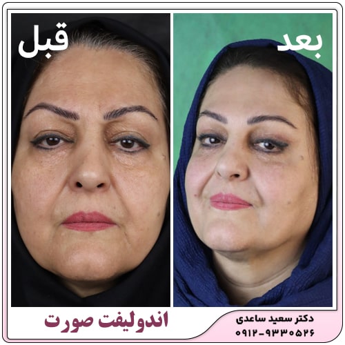 نمونه کار اندولیفت