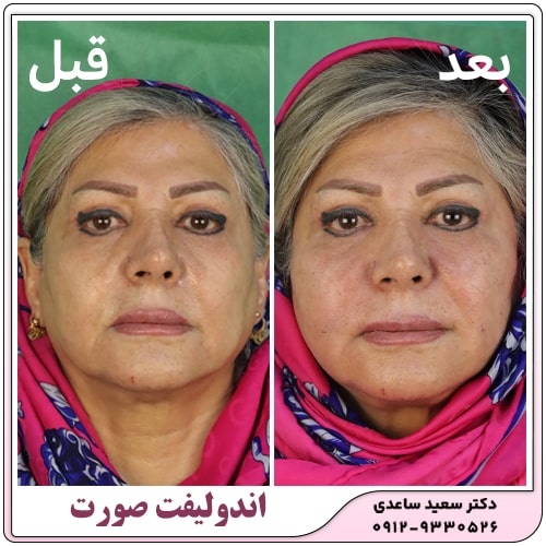 نمونه کار اندولیفت صورت