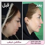 ساکشن غبغب