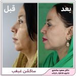 ساکشن غبغب
