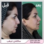 ساکشن غبغب
