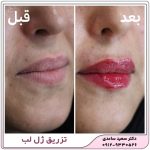 تزریق ژل لب