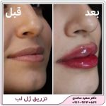 تزریق ژل لب