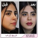 تزریق ژل لب