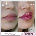 تزریق ژل لب
