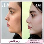 بلفاروپلاستی