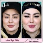 بلفاروپلاستی