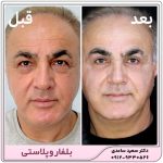 بلفاروپلاستی