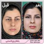 بلفاروپلاستی