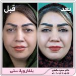 بلفاروپلاستی