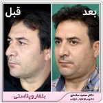 بلفاروپلاستی