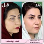 بلفاروپلاستی