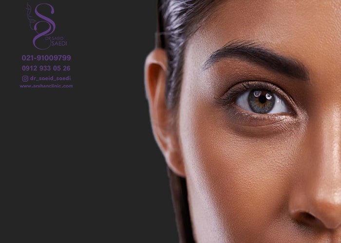 عمل چشم گربه ای با بوتاکس