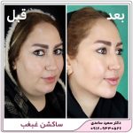 ساکشن غبغب
