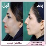 ساکشن غبغب