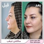 ساکشن غبغب