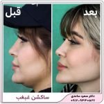 ساکشن غبغب