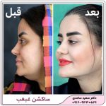 ساکشن غبغب
