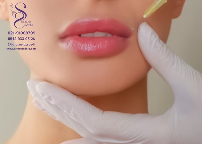 تخلیه ژل تزریق شده از طریق تزریق هیالورونیداز