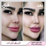 تزریق ژل لب