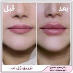 تزریق ژل لب