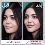 تزریق ژل لب