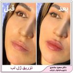تزریق ژل لب