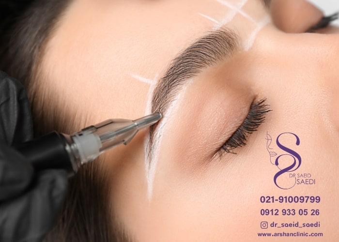 کاشت ابرو شیر دهی