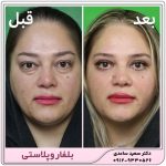 بلفاروپلاستی