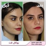بوکال فت