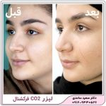 لیزر co فرکشنال