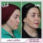 ساکشن غبغب