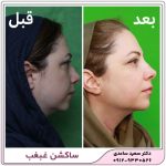 ساکشن غبغب