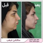 ساکشن غبغب