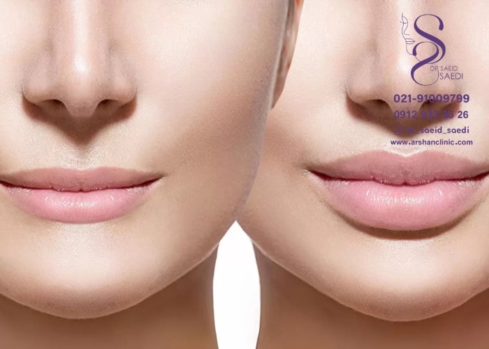 عوارض ژل لب روسی