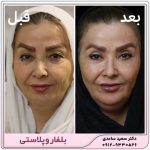 بلفاروپلاستی