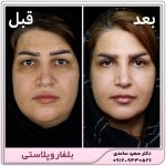 بلفاروپلاستی