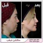 ساکشن غبغب