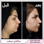 ساکشن غبغب