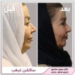 ساکشن غبغب